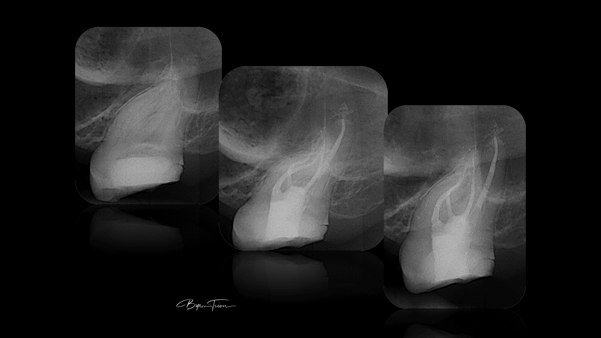 Broken Instrument Removal - Case 6